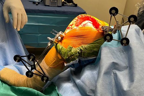 Robotic Knee Replacement