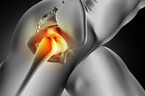 Hip & Pelvic Acetabular Surgery