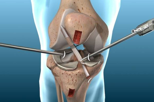 Arthroscopy