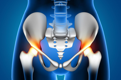 Hip Replacement